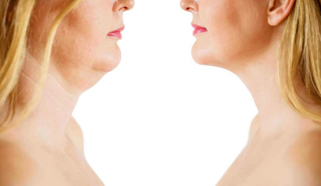 Double Chin treatment Merseyside before and after results