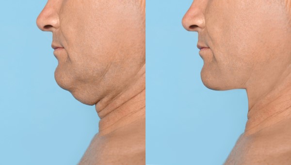 Which Non-Surgical Treatments Work Best for Jowls and Loose Skin Merseyside?