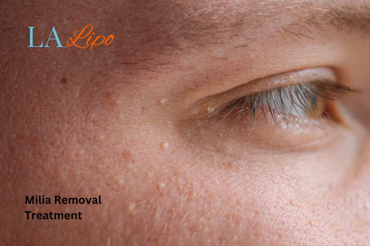 Cryopen Milia Removal: Is It the Easiest and Safest Option Merseyside?