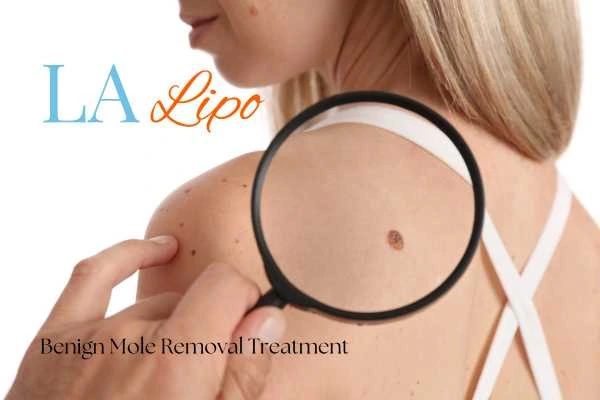 Why getting moles removed Merseyside can boost your confidence!