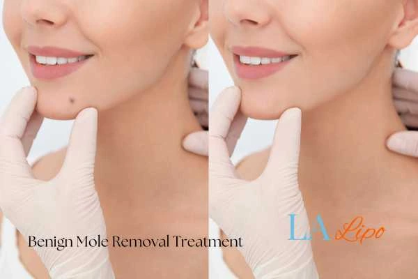 woman's before and after mole removal Merseyside results