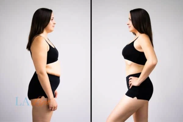 image of woman before and after results of LA-EMS Body Sculpting Merseyside to help treat Diastasis recti