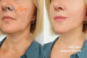 hi-fu for wrinkles Merseyside before and after results