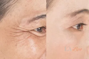 Before and after results of woman - HI-fu wrinkles reduction treatment Merseyside