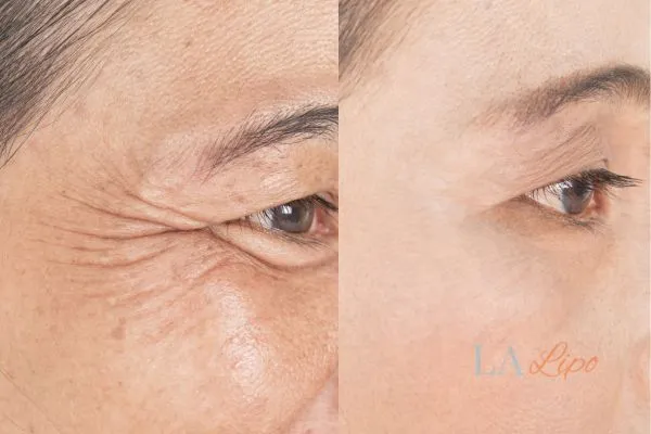 Before and after results of woman - HI-fu wrinkles reduction treatment Merseyside