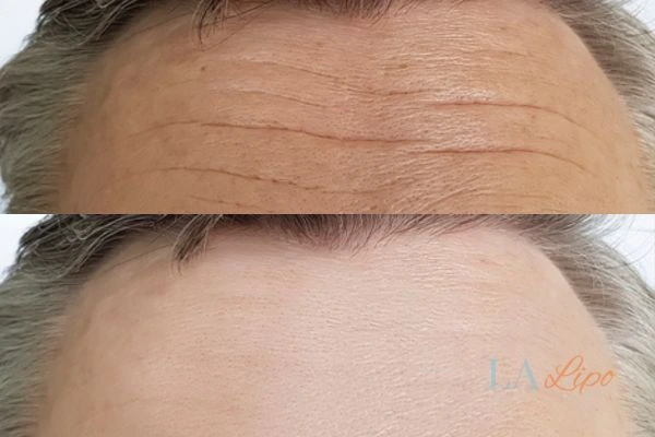 results of HIFU Merseyside on mans forehead to help reduce lines and wrinkles