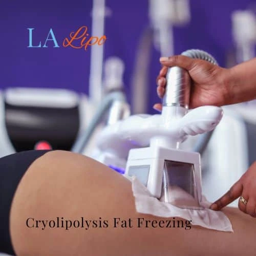 fat freezing - Cryolipolysis Merseyside