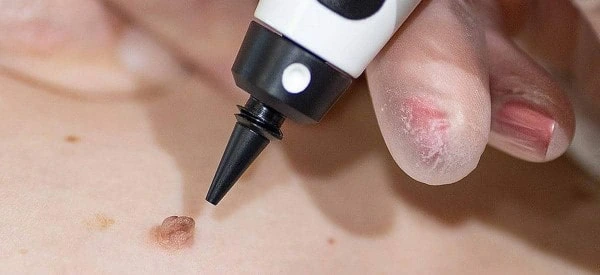 skin tag removal using cryopen Merseyside