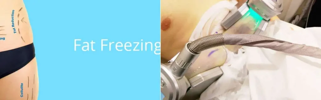 Fat freezing Merseyside on multiple areas of the body