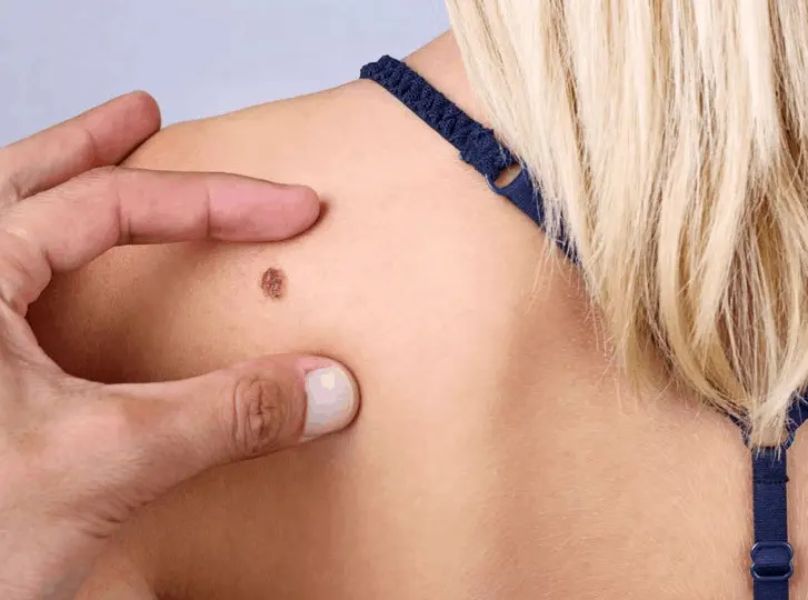woman having mole removal Merseyside consultation before treatment.