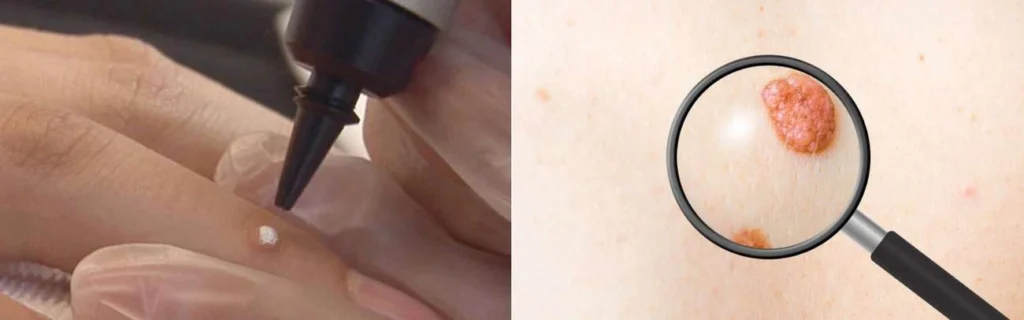 Person getting moles removed with cryopen Merseyside