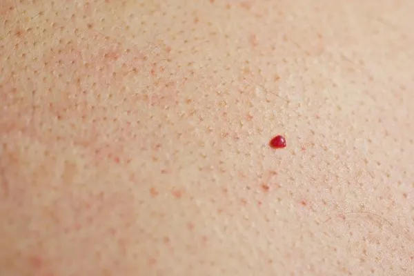 close up of a cherry angioma Merseyside