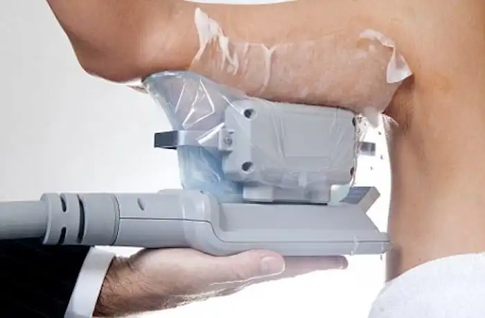 Picture of fat freezing Merseyside on the upper arms.