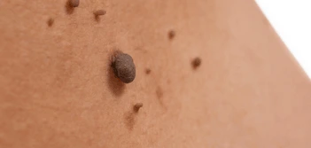 image of a skin tag Merseyside
