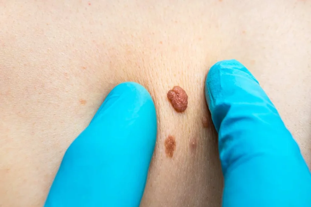 Consultant examining a skin tag Merseyside