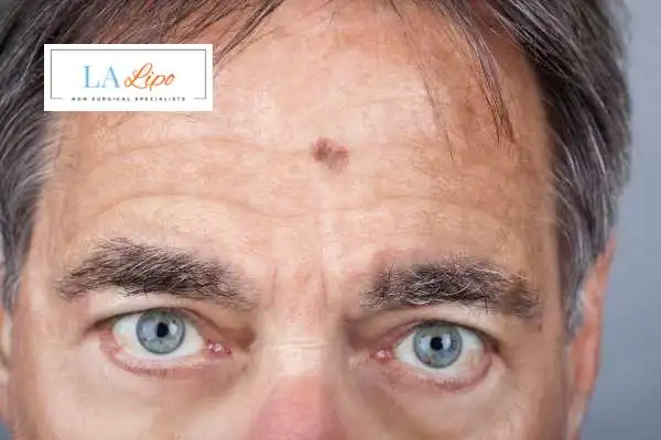 Solar Lentigo Removal Merseyside image of man with mark on his forehead