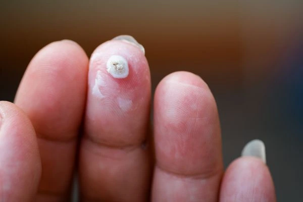 wart on person finger - cryotherapy to treat from LA LIPO Merseyside