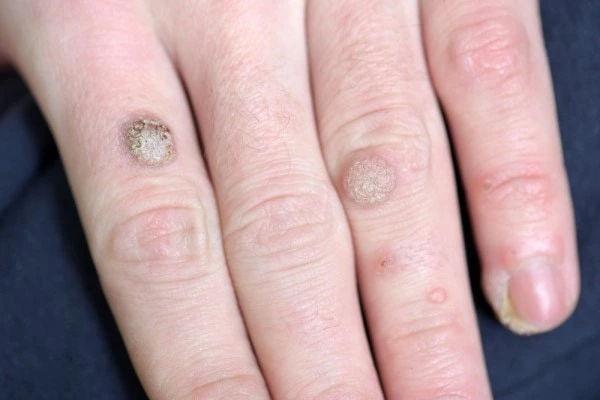 photo of warts on person hand - see wart removal Merseyside from LA LIPO