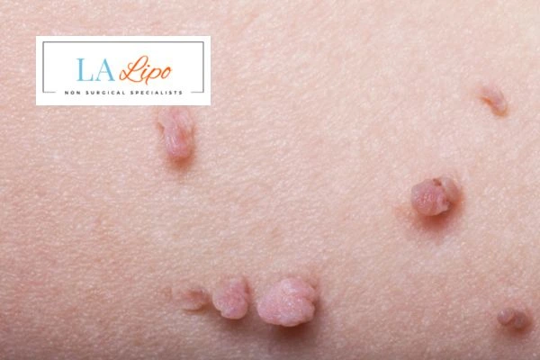 Does cryopen skin tag removal Merseyside hurt? Find out now call our team today!