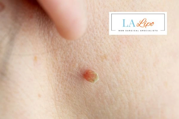 Book skin tag removal Merseyside today speak to our team now!