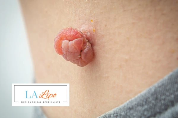Interested in skin tag removal Merseyside? Concerned about the pain? Find out more today!