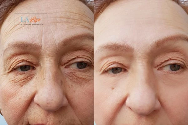 The powerful benefits of Morpheus8 Treatment Merseyside - Call Our team today!