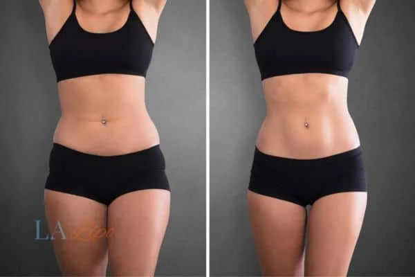 before and after results of non-surgical treatment to help a woman's body image and mental health Merseyside