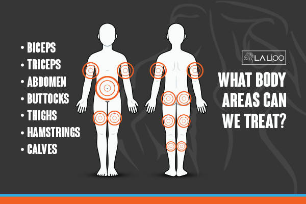 Diagram to show areas you can have LA-EMS Body Sculpting Treatment Merseyside