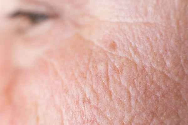 close up picture of a woman's face showing an age spot Merseyside