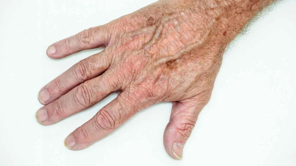 Male hand showing age spot Merseyside