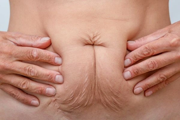 Image of a woman's stomach with loose skin - example of skin tightening Merseyside options