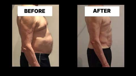 What Symptoms Can Diastasis Recti Cause in Men? Weak Core, Back Pain and Poor Posture Merseyside
